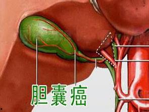 明星 胆囊癌,胆囊癌阴影下的生命挑战